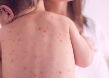 ХӨСҮТ: Улаанбурхан өвчний батлагдсан тохиолдол 23 нэмэгджээ