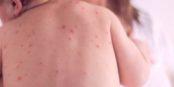 ХӨСҮТ: Улаанбурхан өвчний батлагдсан тохиолдол 23 нэмэгджээ